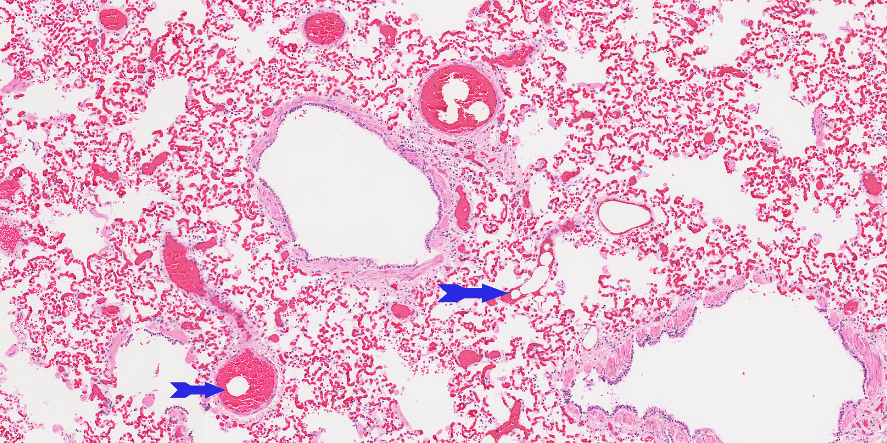 Causes, Clinical Manifestations, and Treatment of Fat Embolism