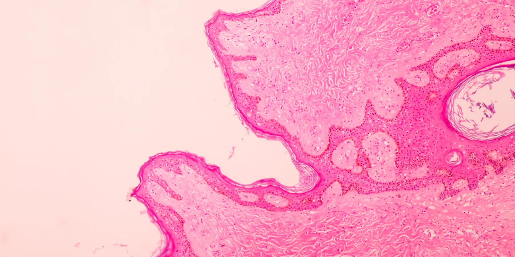 breast cancer
