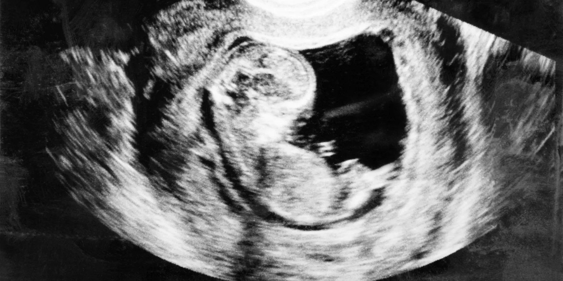 ultrasound