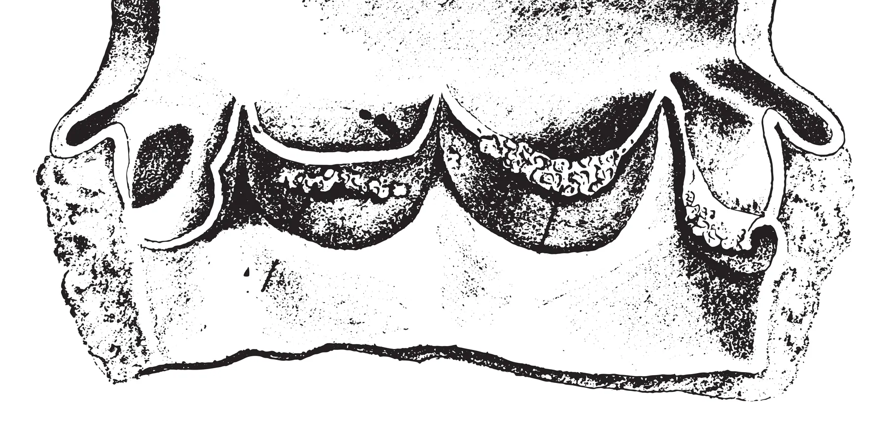 infective endocarditis