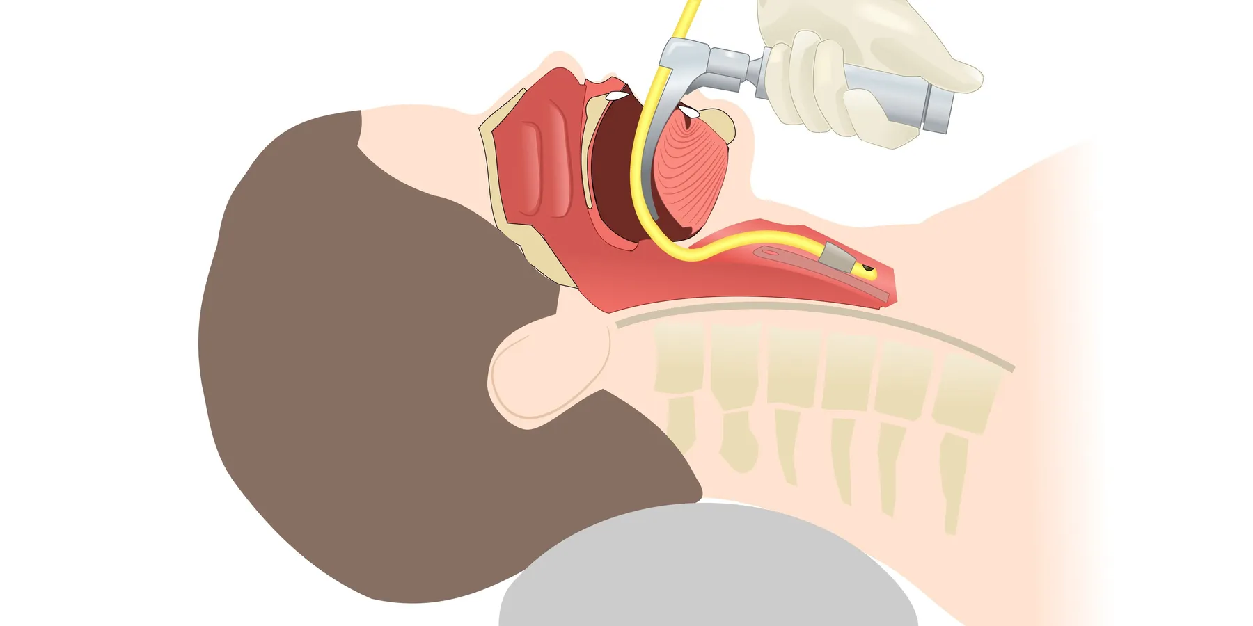endotracheal intubation