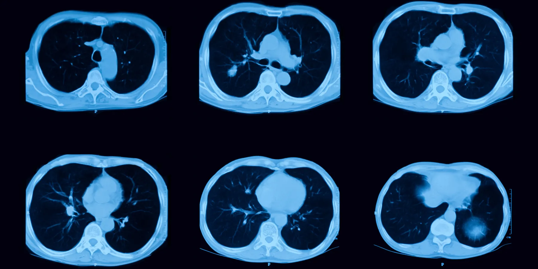 lung CT scan