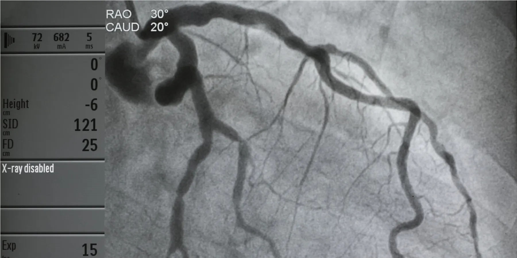 cardiac catherization