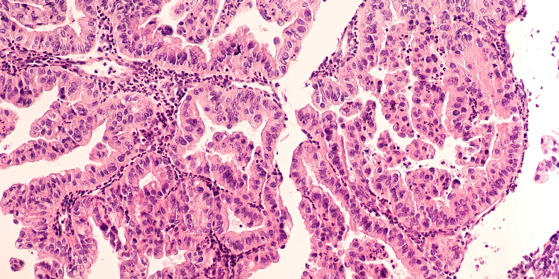 gynecological cancer