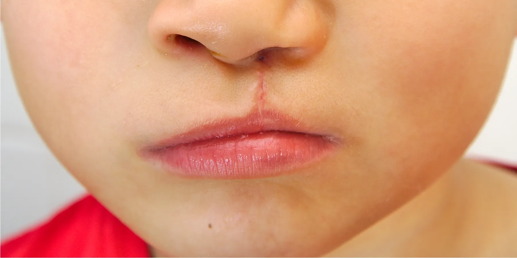 cleft palate