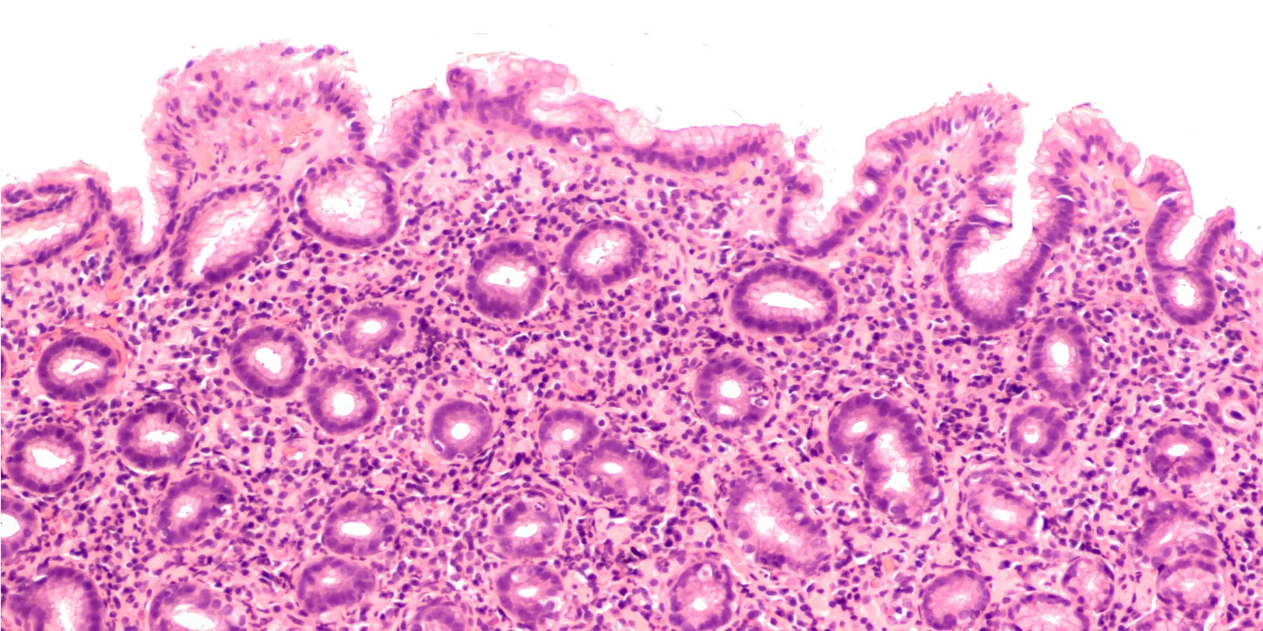 helicobacter pylori