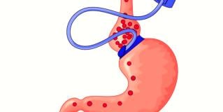 bariatric surgery