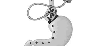 bariatric surgery