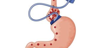 bariatric surgery