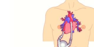 LVAD