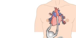 LVAD