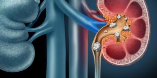 kidney stone