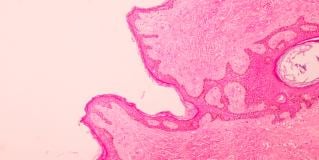 breast cancer
