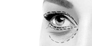 blepharoplasty