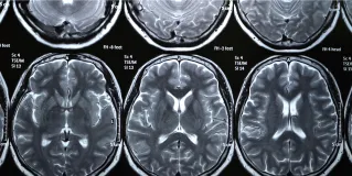 neuroimaging