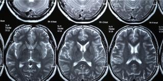 neuroimaging