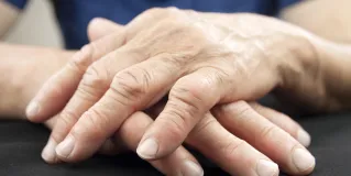 rheumatoid arthritis