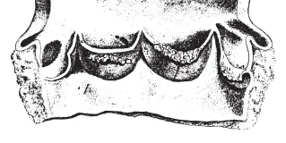 infective endocarditis