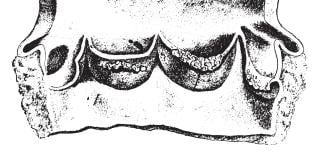 infective endocarditis