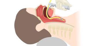 endotracheal intubation