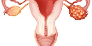 ovarian cancer