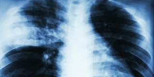 pneumonia