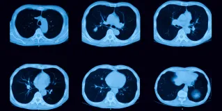 lung CT scan