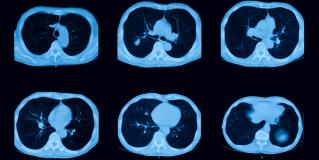 lung CT scan