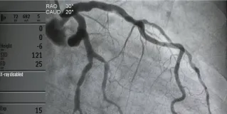 cardiac catherization