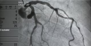 cardiac catherization