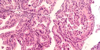 gynecological cancer
