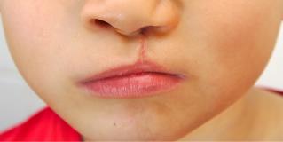 cleft palate