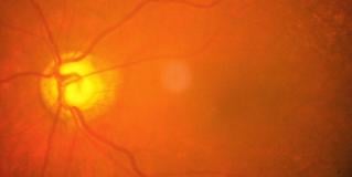 glaucoma