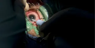 cataract surgery