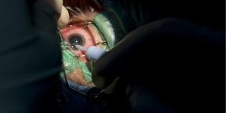 cataract surgery