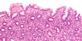 helicobacter pylori