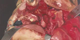 Extended maxillectomy
