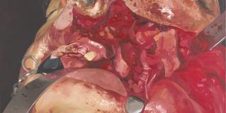 Extended maxillectomy