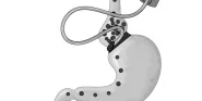 bariatric surgery