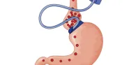 bariatric surgery