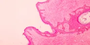 breast cancer