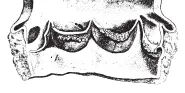 infective endocarditis