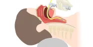 endotracheal intubation