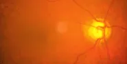 retina