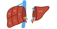 living liver donation