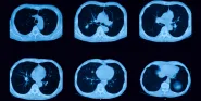 lung CT scan