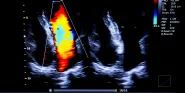 ultrasound