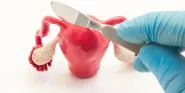 salpingectomy