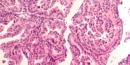 gynecological cancer