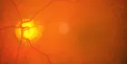 glaucoma